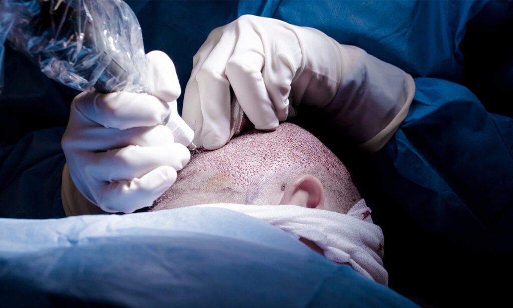 Greffe de Cheveux Sommeil (Sedo-Anelgesia) 8 hair transplant sa 3